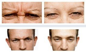 Before & After - Wrinkle Doctor