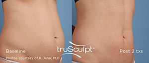 Trusculpt ID: Defining Your Body ID With Personalized Body Sculpting